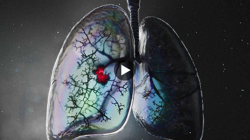 Lung Tumor Growth